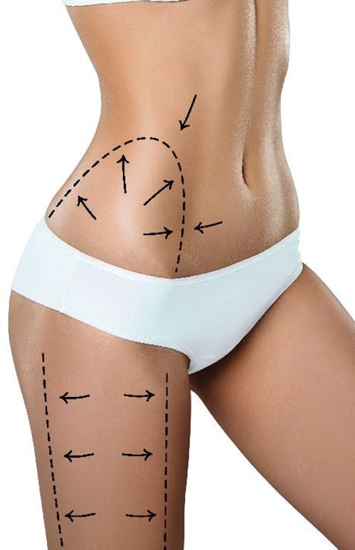 Body Contouring Carboxy therapy
